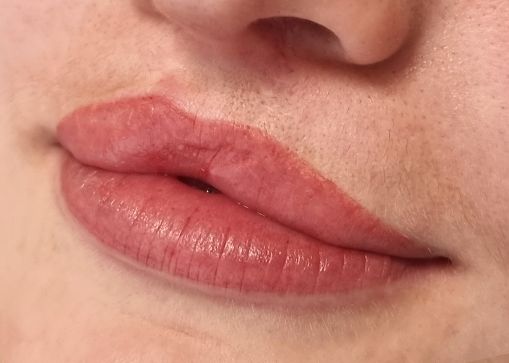lippen 2 nachher