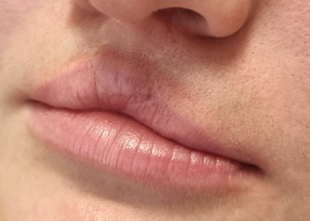 lippen 2 vorher