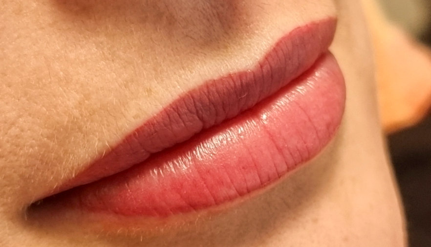 lippen 4 nachher