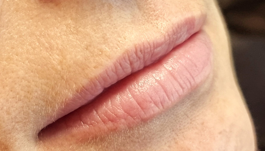 lippen 4 vorher
