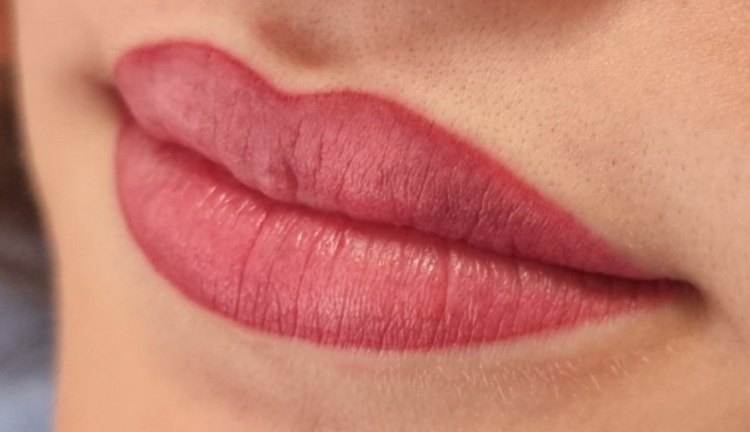 lippen 5 nachher