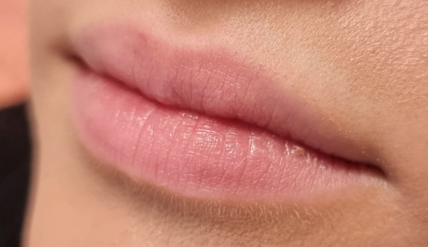 lippen 5 vorher