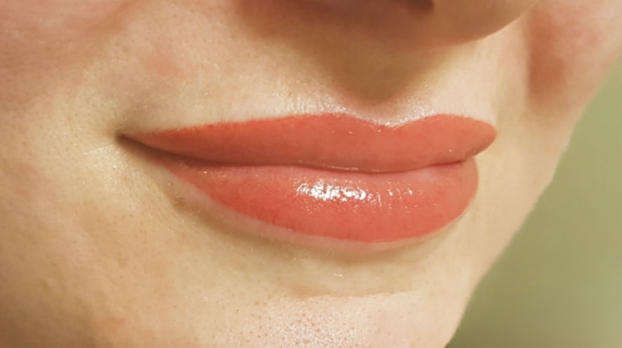 lippen 6 nachher
