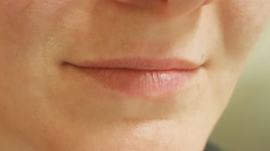 lippen 6 vorher